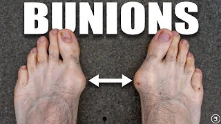 Bunions | Hallux Valgus (Diagnosis, Exercises, Treatment)