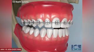 Di̇ş Telleri̇ni̇n Görevlerleri̇ Ve Calişmasi İmasyon