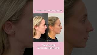 Full Facial Balancing Treatment Results #fillers