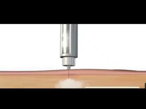 როგორ ვაკეთებთ ინსულინს (ფენის) მეშვეობით.