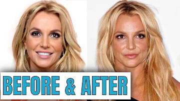 Are Britney Spears teeth veneers?