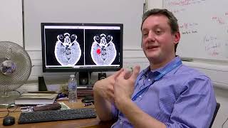 New AI software could double stroke diagnosis accuracy | REUTERS