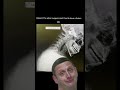 🔓🏃♂️ Unlock Mobility with Cervical Disc Replacement: Preserve Motion & Speed Recovery! 🙌💡