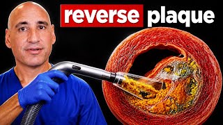 How To REVERSE PLAQUE Naturally (Heart Doctor Explains)