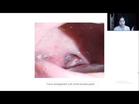 Mini lecture 12 Infectious mononucleosis Clinical presentation & treatment
