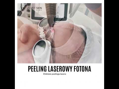 Fotona Laser Peel — Treatment Results