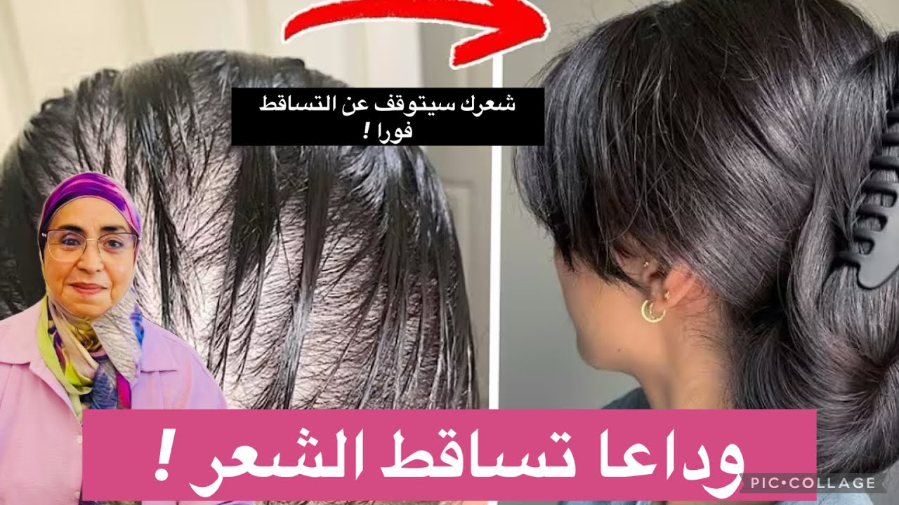 وداعًا لتساقط الشعر | وصفة طبيعية لوقف التساقط وتكثيف الشعر بسرعة