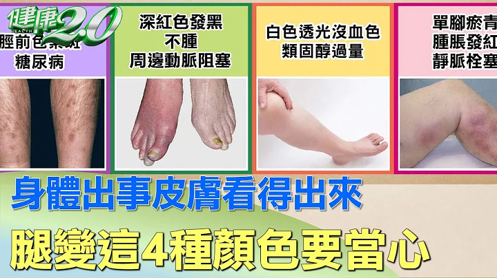 身体出事皮肤看得出来 腿变这4种颜色要当心 健康2.0 - 天天要闻