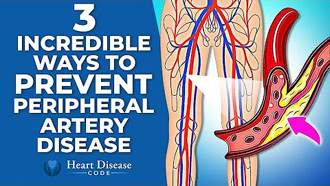 3 Incredible Ways to Prevent Peripheral Artery Disease