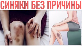 КАК БЫСТРО ПРОХОДЯТ СИНЯКИ | Как быстро убрать синяк