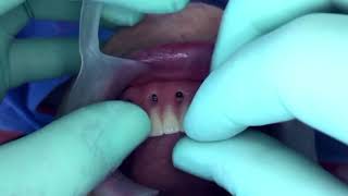 Adiós a las prótesis flojas. screenshot 3