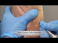 Satisfying Callus Removal- NO BLOOD