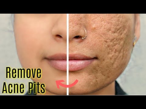  DAYS CHALLENGE TO REMOVE ACNE SCARS, GET SMOOTH, FLAWLESS SKIN