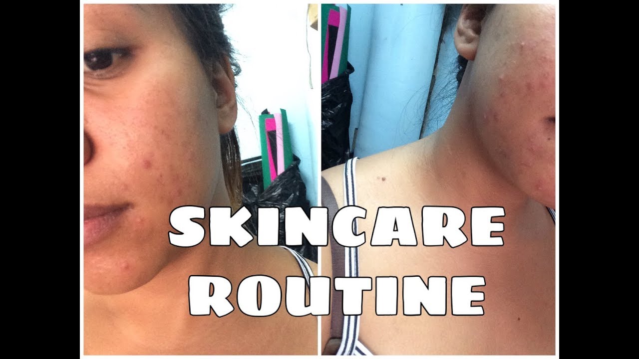 ACNE SKINCARE | solusyon sa pimples at acne scars