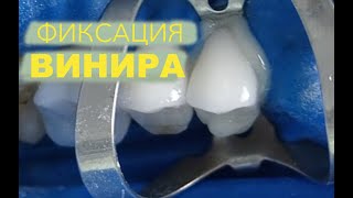 Фіксація Вініра Variolink N