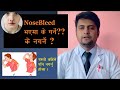          nose bleeding problem    how to control nosebleed 