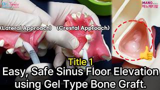 [ENG]Title 1 : Easy, Safe Sinus Floor Elevation using Gel Type Bone Graft. Sinus Floor Elevation