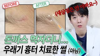 [6살 환자 사례] 봉합 후 생긴 패인흉터 치료! #새살침 #패인흉터 #봉합흉터