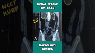 Renal stones on CT scan made simple for USMLE, NEET PG, INICET, NCLEX Ct Scan For Kidney Stone