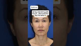 UPDATE on 60 Year Old Facelift: 4 Month Post-Op Results