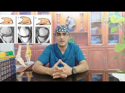 علاج تمزق الغضروف الهلالي من الدرجة الأولى علاج اصابة الغضروف الهلالي اصابة الغضروف الهلالي