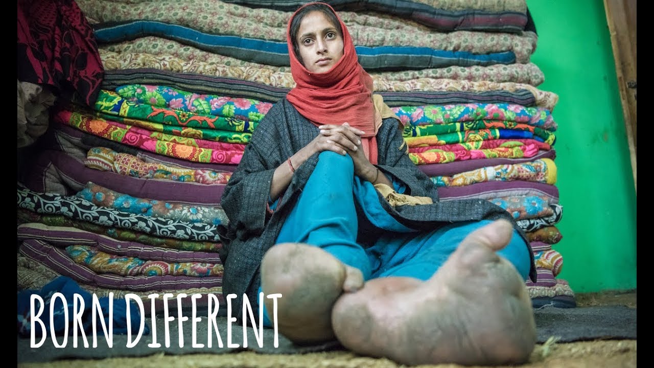 The Woman With The Giant Feet | BORN DIFFERENT