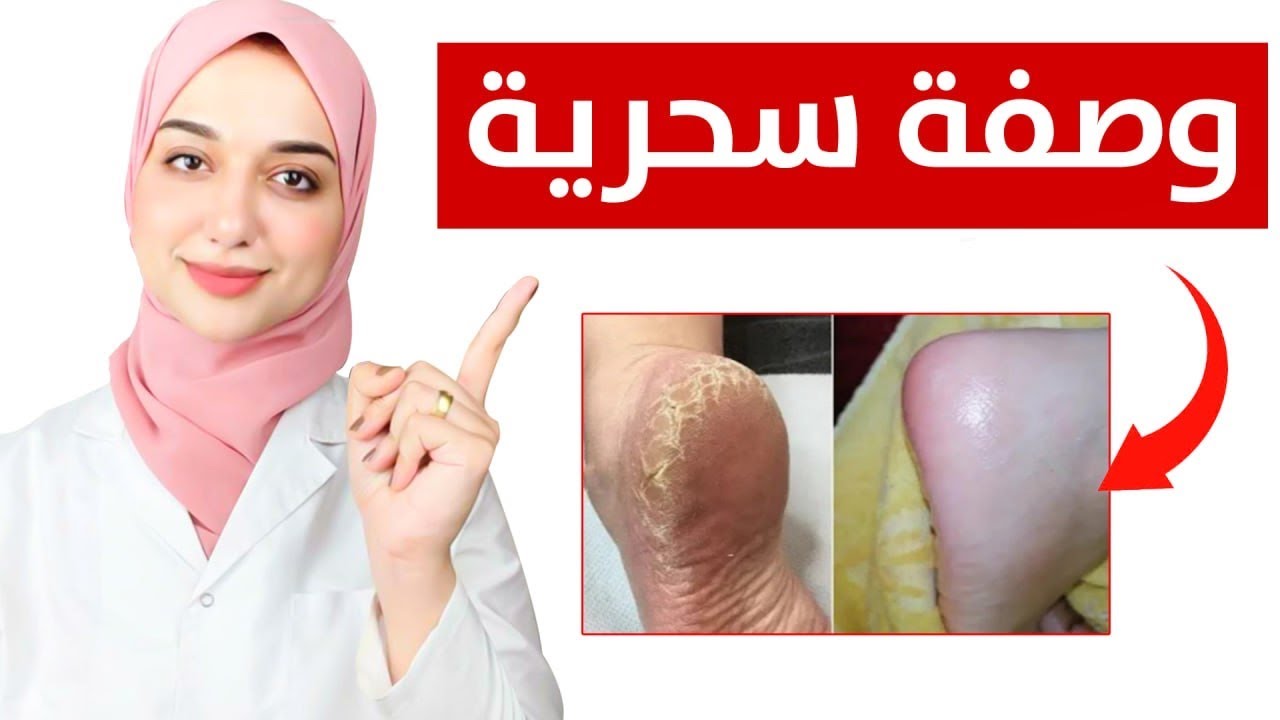 وصفه للتخلص من تشققات القدمين من اول استخدام مهما كان شكلها / تنعيم كعب القدم في دقايق