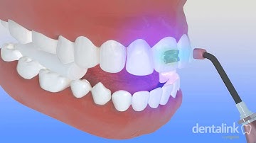 Colocación de brackets - PROCESO de cementación paso a paso 3D