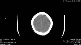 CASE 1021 CT BRAIN SCHIZENCEPHALLY @educationalradiologychanne9079