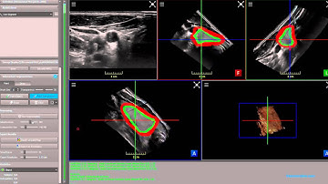Interactive segmentation of Thyroid using Imfusion
