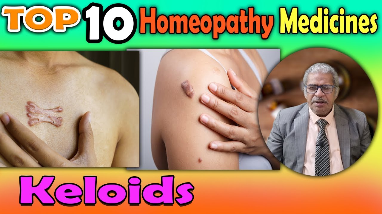 Keloids: Symptoms and #homeopathy medicines -- Dr P S Tiwari