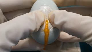 ASMR excision of abscess