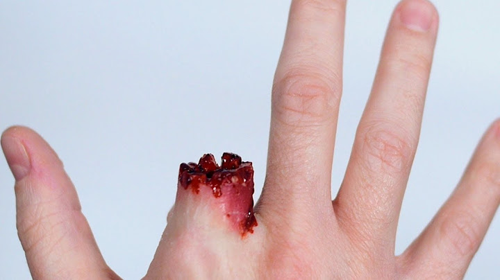 تعمل اية لو شخص صباعة أتقطع وكيف تحافظ علي الجزء المبتور_First aid for finger amputation