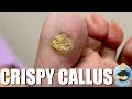 SCRAPING OFF A HUGE TOE CALLUS