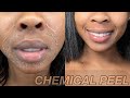 Chemical Peel Final Update | GRAPHIC CLIPS