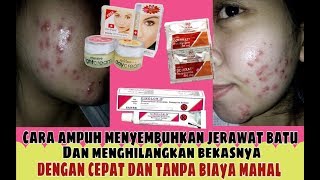 Efektif, Ini Cara Paling Ampuh Menghilangkan Jerawat Batu dengan Skincare!