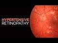 Hypertensive Retinopathy | Stages | Keith-Wagener-Barker classification