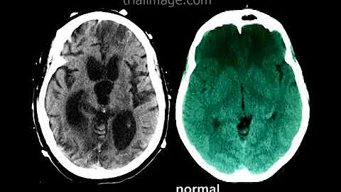 Hydrocephalus due to Colloid Cyst Animation by Cal Shipley, M.D.