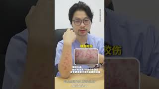 夏天這幾種蟲咬傷注意分辨,學會對應的處理方法#盧驍的急診日記 #蟲咬