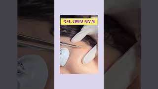 #삼성맑은피부과 #피부과전문의 #판교피부과 #분당피부과 #흑자제거 #검버섯제거 #리팟레이저
