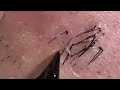 【Plucking facial hair】ずっと見てられる世界のヒゲ抜き 2018 7 4 (アゴヒゲ編)