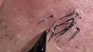 【Plucking facial hair】ずっと見てられる世界のヒゲ抜き 2018 7 4 （アゴヒゲ編）