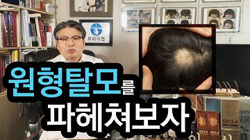 원형탈모를 자세히 파헤쳐보자