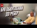 😱 Боялись, що &quot;розсиплеться&quot;! Медики врятували бійця з опіками, для яких немає кваліфікації