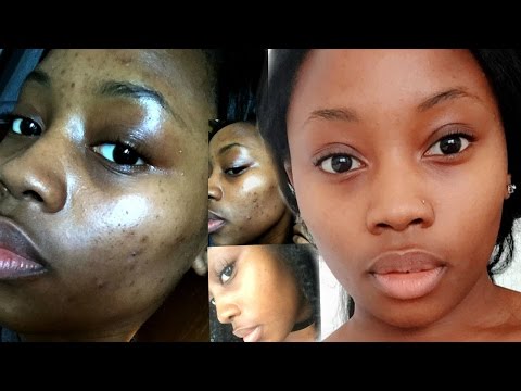 HOW TO: CLEAR ACNE IN  WEEKS ON A BUDGET! ALL NATURAL PRODUCTS