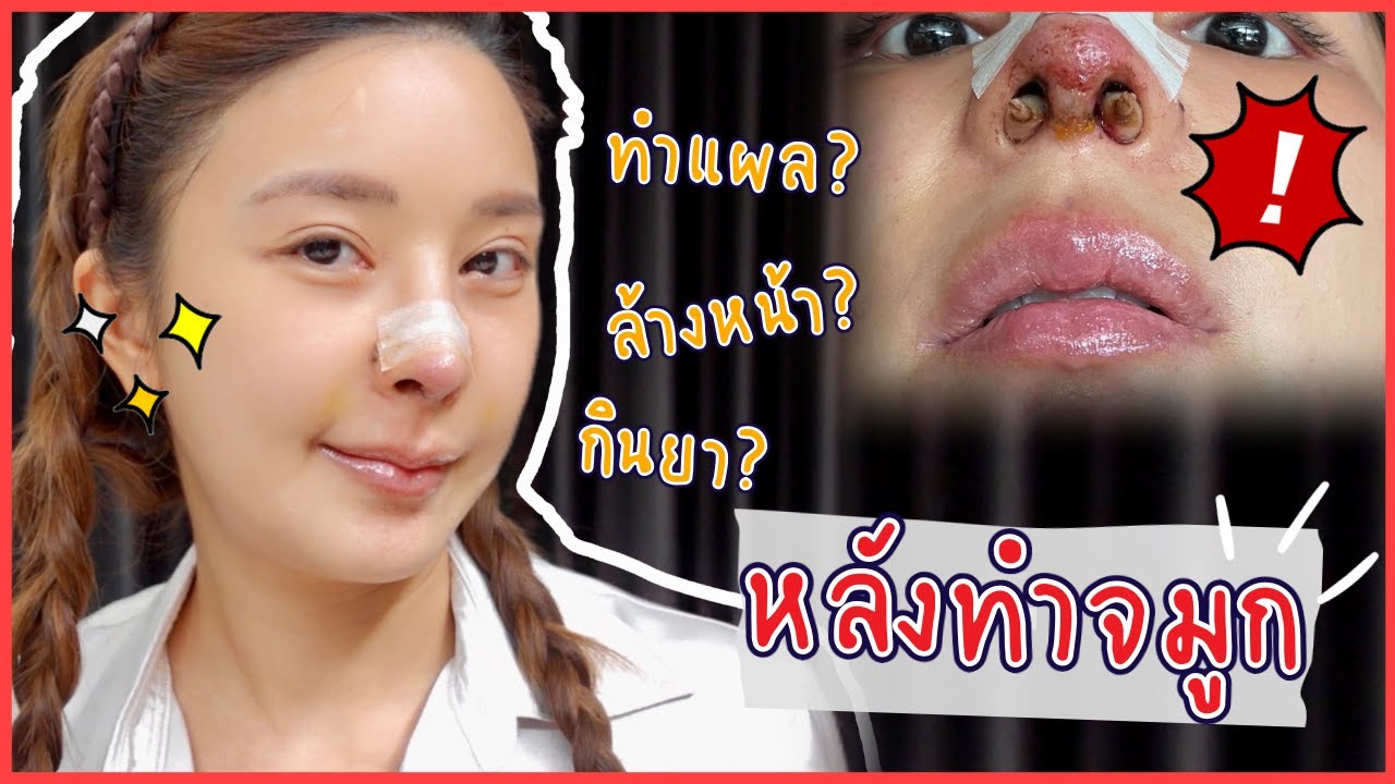 การดูแลหลังทำจมูก บอกหมดทุกขั้นตอน!!! | Yae uunws