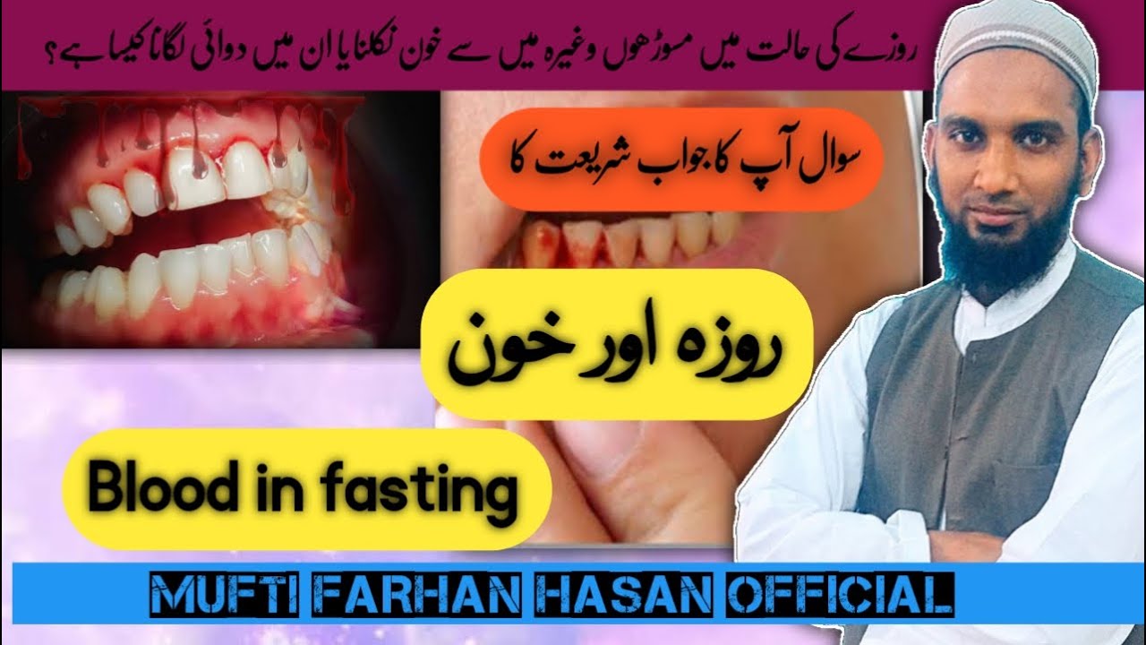 Roze main Daanton se khoon ana | Dant main dawa lagana | Bleeding from ...