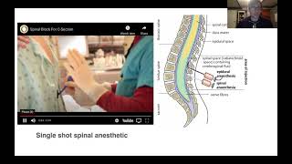 University of Kentucky Anesthesiology, Neuraxial Anesthesia Topics - (Dr. Gist)