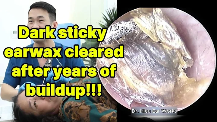 Dark sticky earwax cleared after years of buildup | ear cleaning | ASMR earwax | soothing |relax|