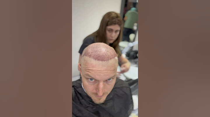 KOLIK STOJÍ TRANSPLANTACE/NASTŘELOVÁNÍ VLASŮ ?! Part 1 #transplantace #vlasy #hair